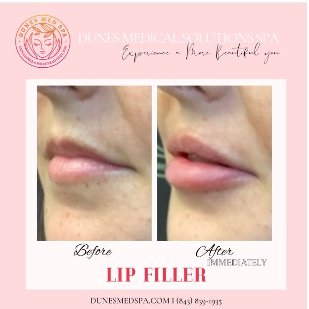 Lip Filler Before and After Results - Immediate transformation