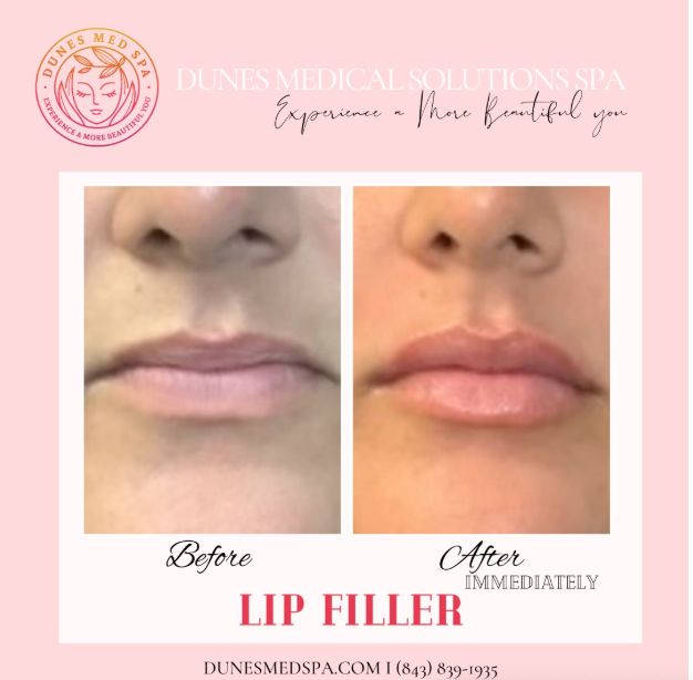 Professional Lip Filler Results - Before and After